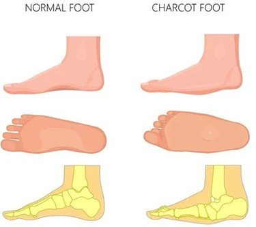 Charcot Foot