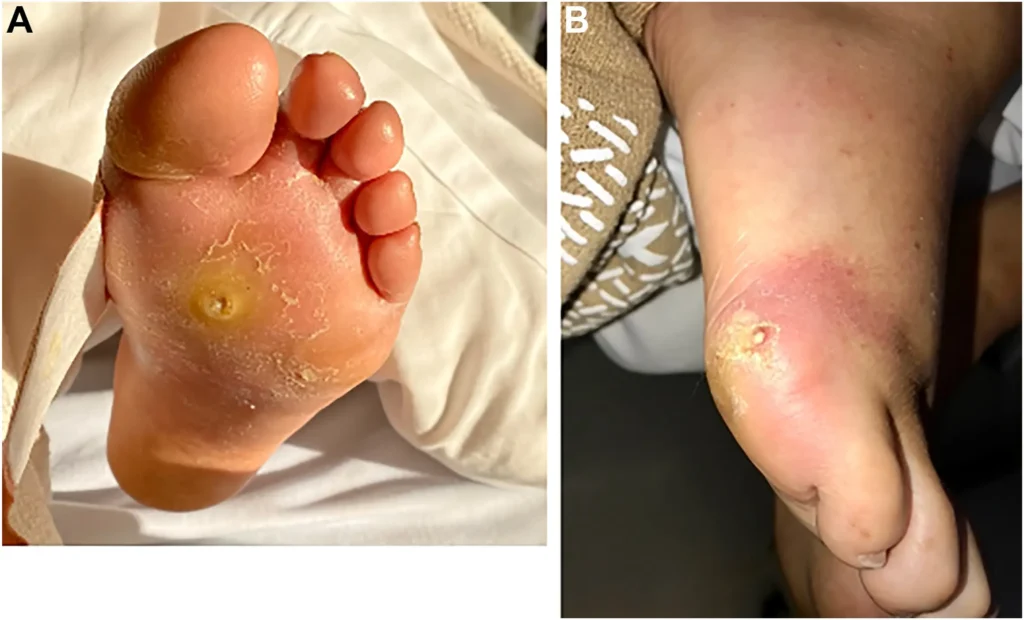 Diabetic Foot