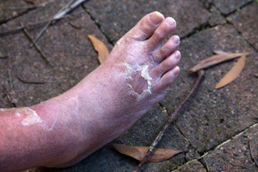 Diabetic Foot Infections