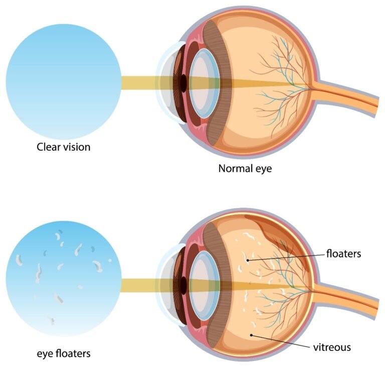 Diabetic Retinopathy