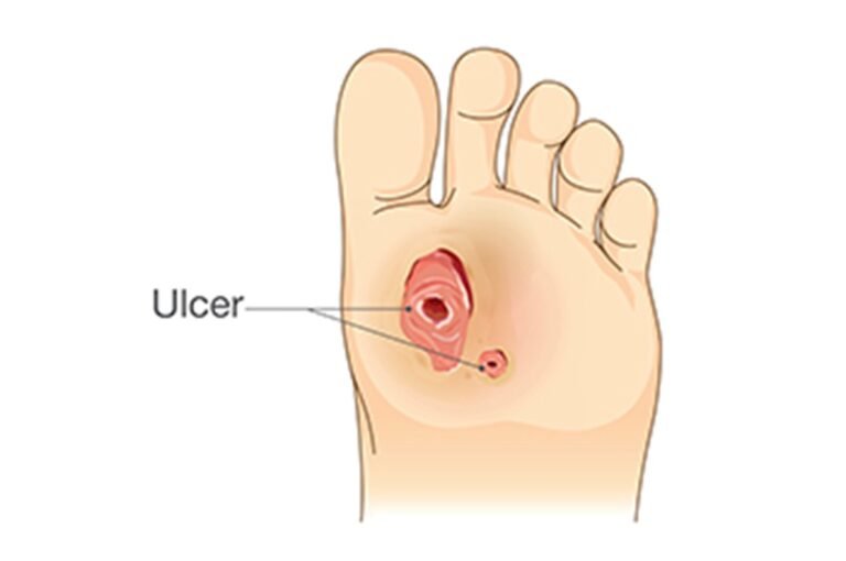 Foot Care in Preventing Diabetic Foot Ulcers