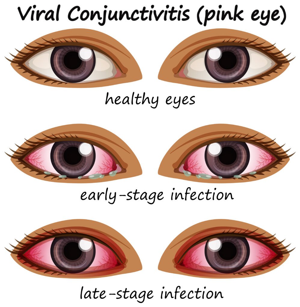 How to Prevent Pink Eye