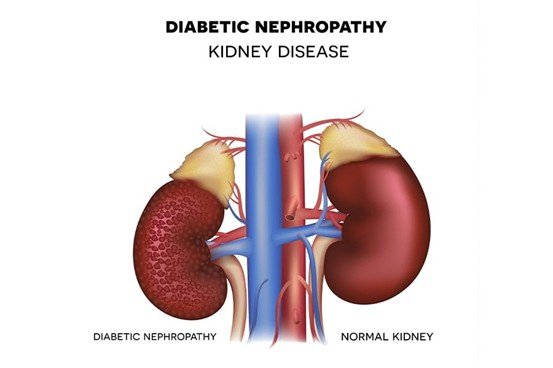 Pathophysiology of Diabetic Nephropathy