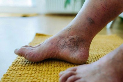 Preventing Diabetic Foot Ulcers