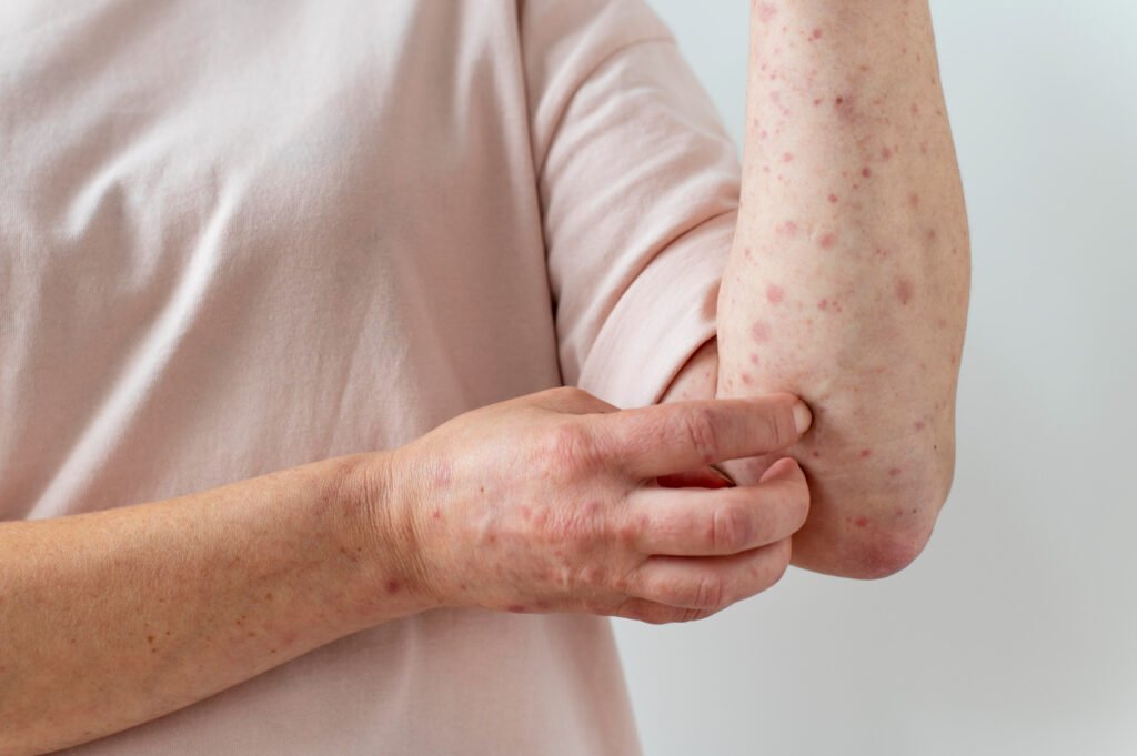 Seborrheic Dermatitis