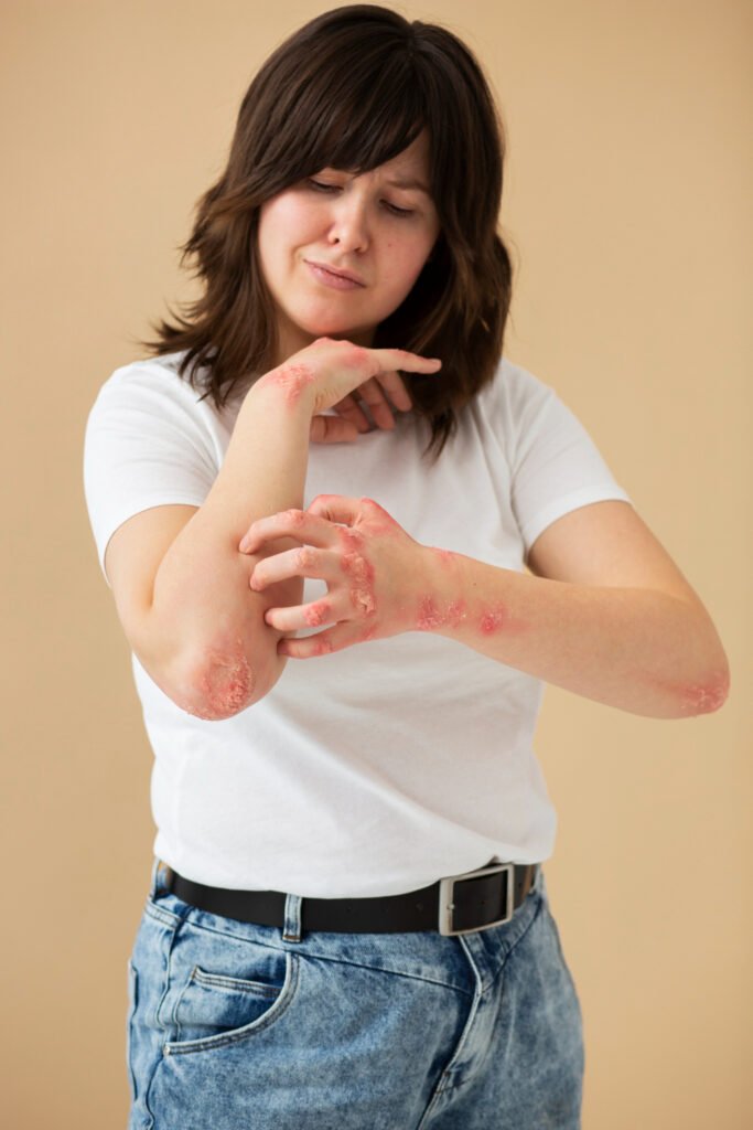 Keratosis Pilaris