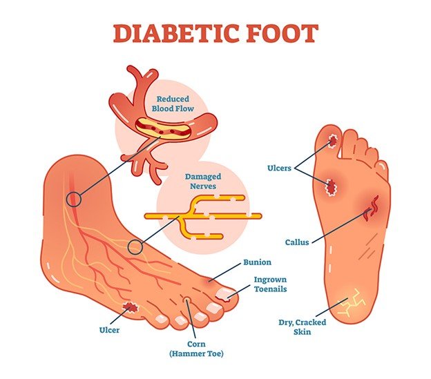 Treating Diabetic Foot Ulcers