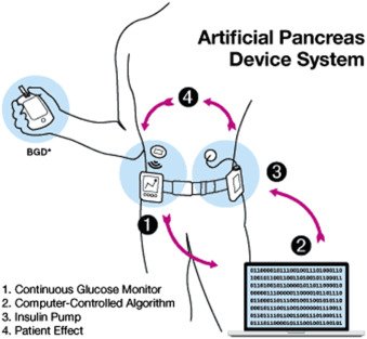 Artificial Pancreas Technology