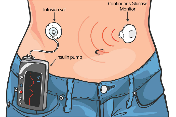 Continuous Subcutaneous Insulin Infusion