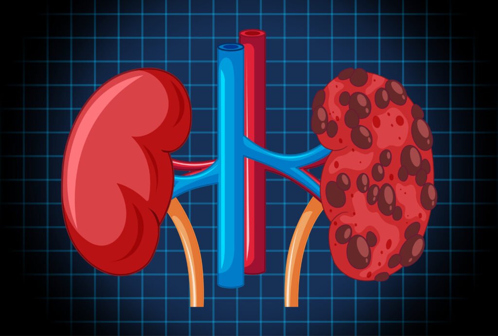 Diabetes Dialysis